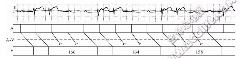 长PR间期型莫氏现象