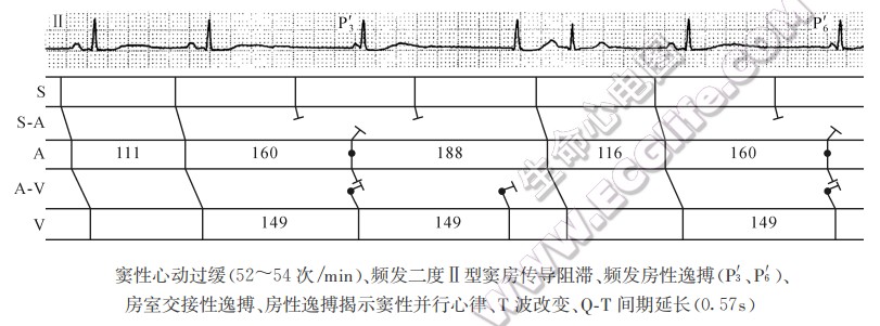 窦性心动过缓(52-54次/min)、频发二度Ⅱ型窦房传导阻滞、频发房性逸搏、房室交接性逸搏、房性逸搏揭示窦性并行心律、T波改变、Q-T间期延长(0.57s)