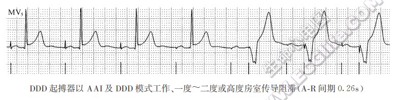 DDD起搏器以AAI及DDD模式工作、一度～二度或高度房室传导阻滞(AR间期0.26s)