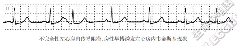 不完全陛左心房内传导阻滞、房性早搏污发左心房内韦金斯基现象