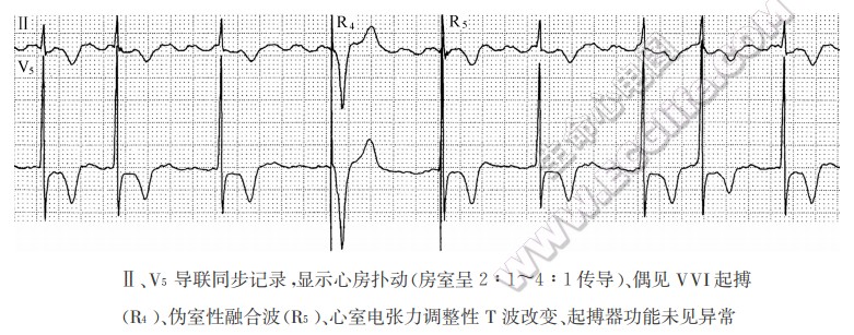 Ⅱ、V5导联同步记录，显示心房扑动（房室呈2：1-4：1传导）、偶见VVI起搏(R4)、伪室性融合波(R5)、心室电张力调整性T波改变、起搏器功能未见异常