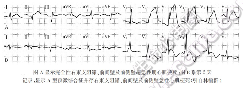 预激综合征合并心肌梗死、束支阻滞、房室传导阻滞