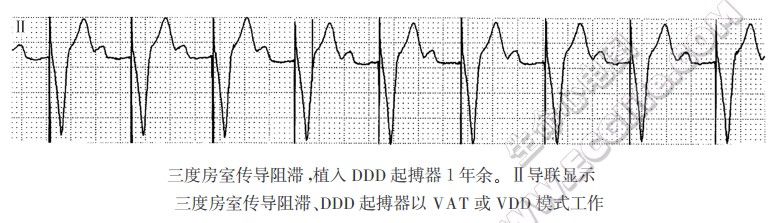 三度房室传导阻滞，植入DDD起搏器1年余。Ⅱ导联显示三度房室传导阻滞、DDD起搏器以VAT或VDD模式工作