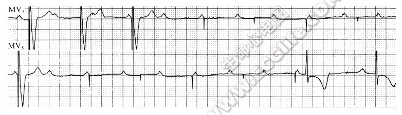 VVI起搏器异常时的心电图