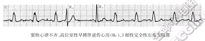 早搏揭示慢频率依赖性束支、分支阻滞（心电图）