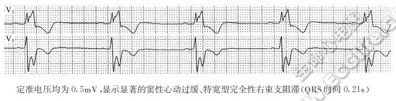定准电压均为0.5mV，显示显著的窦性心动过缓、特宽型完全性右柬支阻滞(QRS时间0.21s)