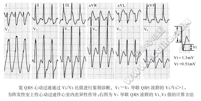 宽QRS心动过速通过Vi/Vt比值进行鉴别诊断。V2～V6导联QRS波群的Vi/Vt>1，为阵发性室上性心动过速伴心室内差异性传导；右图为V5导联QRS波群的Vi、vt值的计算方法