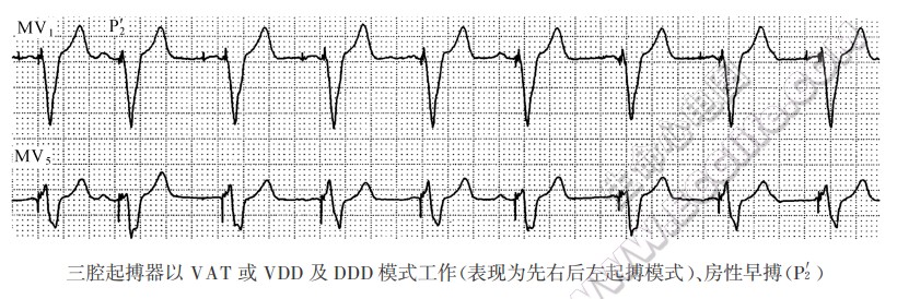 三腔起搏器以VAT或VDD及DDD模式工作（表现为先右后左起搏模式）、房性早搏