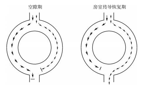 房室结内双径路传导学说示意图