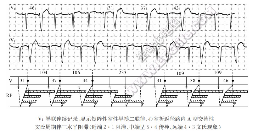 折返径路内三层阻滞