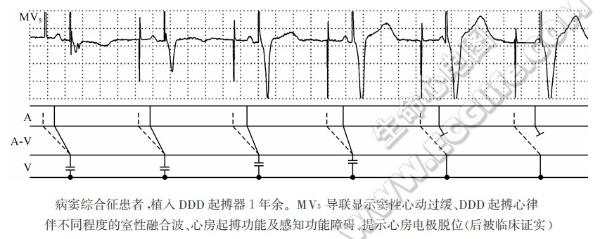 病窦综合征患者，植入DDD起搏器1年余。MV5导联显示窦性心动过缓、DDD起搏心律伴不同程度的室性融合波、心房起搏功能及感知功能障碍、提示心房电极脱位（后被临床证实）