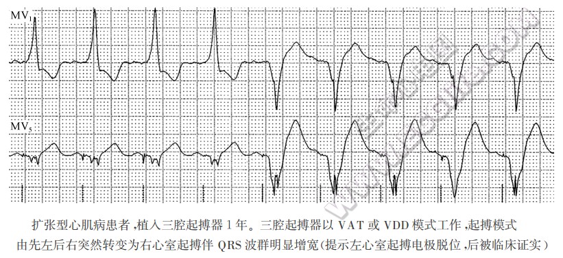 扩张型心肌病患者艚人三腔起搏器1年。三腔起搏器以VAT或VDD模式工作，起搏模式由先左后右突然转变为右心室起搏伴QRS波群明显增宽（提示左心室起搏电极脱位后被临床证实）