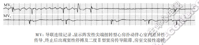 MV1导联连续记录，显示阵发性尖端扭转型心房扑动伴心室内差异性传导、终止后出现窦性停搏及二度Ⅱ型窦房传导阻滞、房室交接性逸搏（心电图）