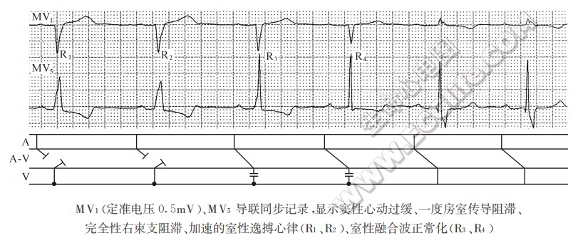 MV1、MV5导联同步记录，显示窦性心动过缓、一度房室传导阻滞、完全性右柬支阻滞、加速的室性逸搏心律、室性融合波正常化（心电图）