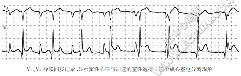 V1、V5导联同步记录，显示窦性心律与加速的室性逸搏心律形成心室电分离现象（心电图）
