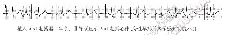 植入AAI起搏器1年余。Ⅱ导联显示AAI起搏心律、房性早搏并揭示感知功能不良
