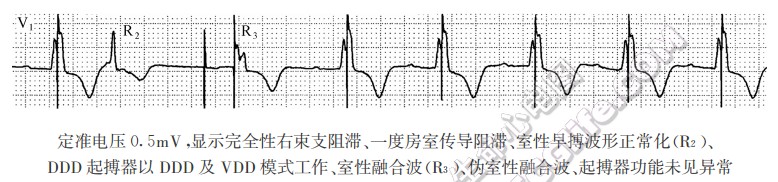 定准电压0.5mV，显示完全陛右柬支阻滞、一度房室传导阻滞、室性早搏波形正常化(R2)、DDD起搏器以DDD及VDD模式工作、室性融合波、伪室性融合波、起搏器功能未见异常