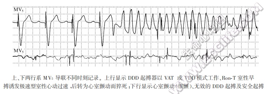 上、下两行系MVs导联不同时刻记录。上行显示DDD起搏器以VAT或VDD模式工作、Ron-T室性早搏诱发极速型室性心动过速，后转为心室颤动而猝死；下行显示心室颤动（细颤）、无效的DDD起搏及安全起搏