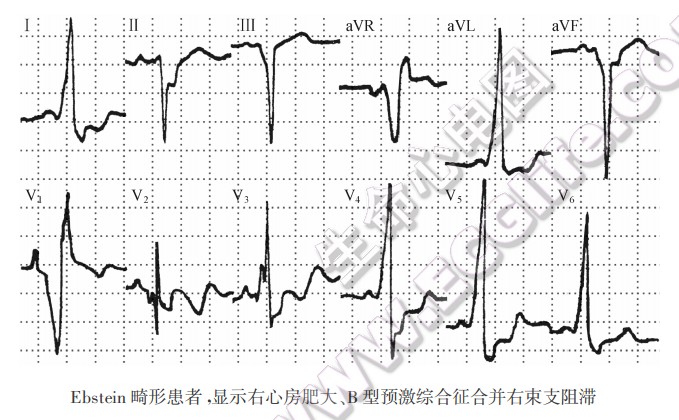 EbsLein畸形患者，显示右心房肥大、B型预激综合征合并右柬支阻滞