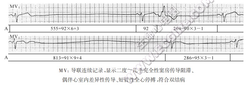 MV1导联连续记录，显示二度～几乎完全性窦房传导阻滞、偶伴心室内差异性传导、短暂性全心停搏，符合双结病（心电图）