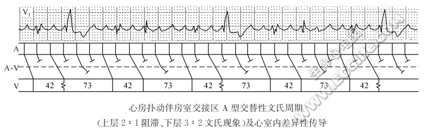 心房扑动伴房室交接区A型交替性文氏周期及心室内差异性传导（心电图）