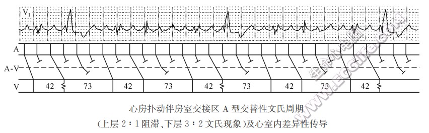 房室交接区内双层阻滞