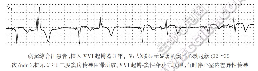 分析有无起搏源性心律失常