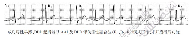 成对房性早搏、DDD起搏器以AAI及DDD伴伪室性融合波模式工作、未开启滞后功能