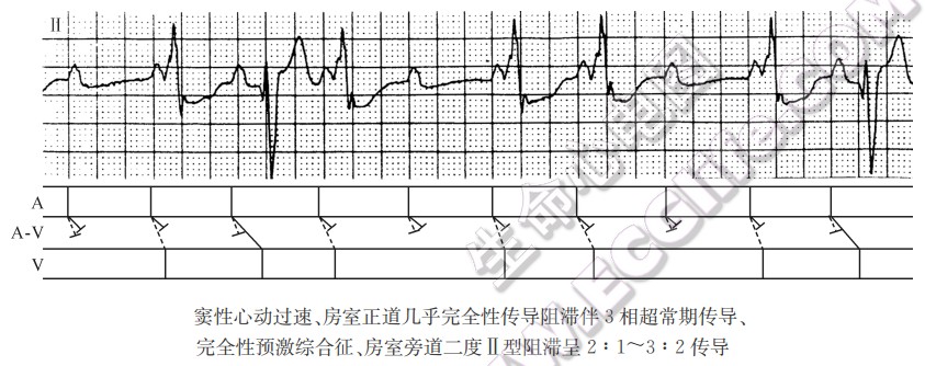 窦性心动过速、房室正道几乎完全性传导阻滞伴3相超常期传导、完全性预激综合征、房室旁道二度Ⅱ型阻滞呈2：1～3：2传导（心电图）