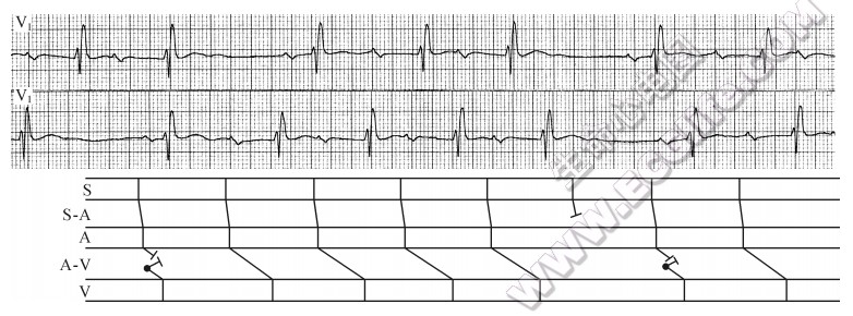 传导系统多部位单层阻滞所组成的多层阻滞（心电图）