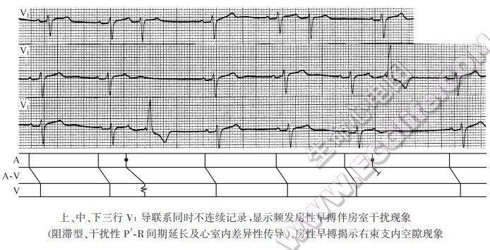 房性早搏揭示束支内空隙现象（心电图）