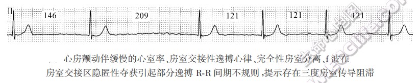 心房颤动伴缓慢的心室率、房室交接性逸搏心律、完全性房室分离、f波在房室交接区隐匿性夺获引起部分逸搏RR间期不规则，提示存在三度房室传导阻滞