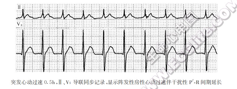 突发心动过速0.5h，Ⅱ、V5导联同步记录，显示阵发性房性心动过速伴干扰性P'R间期延长