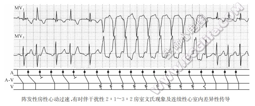 阵发性房性心动过速，有时伴干扰性2：1-3：2房室文氏现象及连续性心室内差异性传导（心电图）