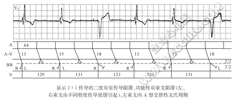 显示2：1传导的二度房室传导阻滞、功能性双束支阻滞（左、右柬支由不同程度传导延缓引起）、左柬支内A型交替性文氏周期（心电图）