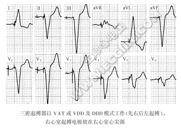 三腔起搏器以VAT或VDD及DDD模式工作（先右后左起搏），右心室起搏电极放在右心室心尖部