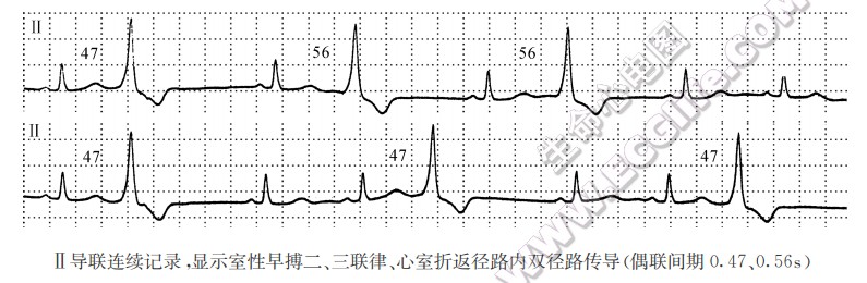 Ⅱ导联连续记录湿示室性早搏二、三联律、心室折返径路内双径路传导