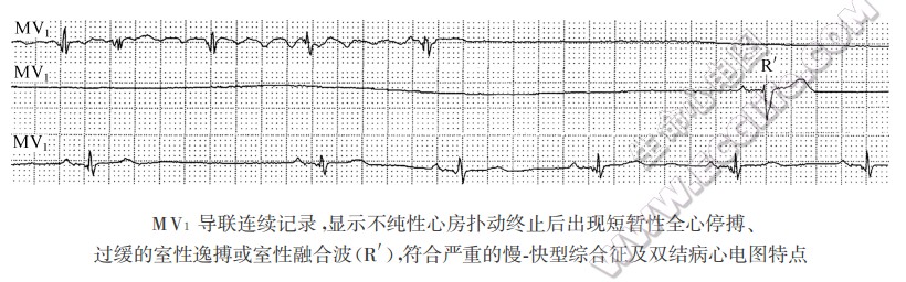 MV1导联连续记录，显示不纯性心房扑动终止后出现短暂性全心停搏、过缓的室性逸搏或室性融合波(R')，符合严重的慢．快型综合征及双结病心电图特点（心电图）