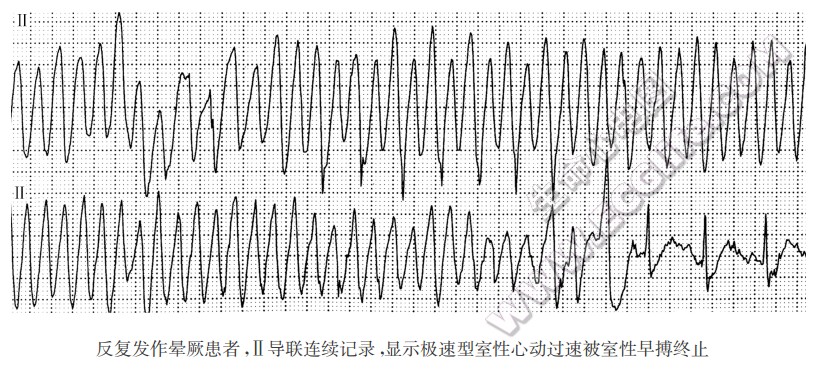 反复发作晕厥患者，Ⅱ导联连续记录，显示极速型室性心动过速被室性早搏终止（心电图）