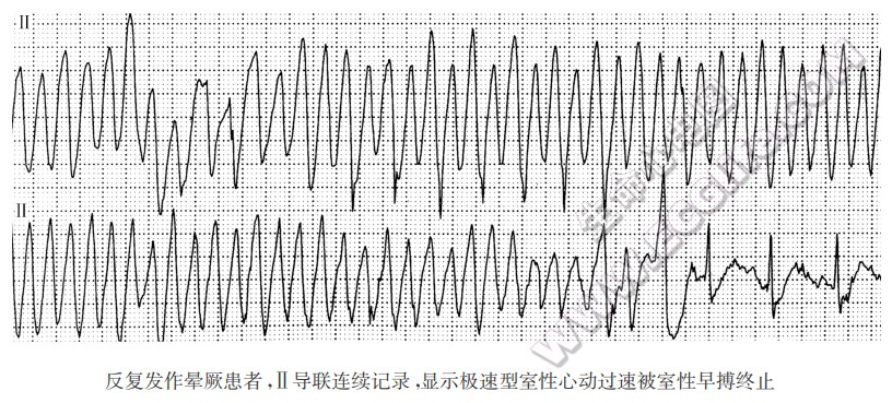 冠心病合并各种心律失常导致心源性猝死