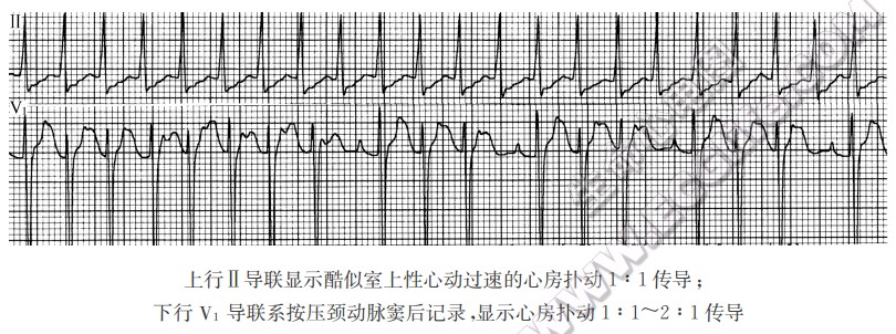 上行Ⅱ导联显示酷似室上性心动过速的心房扑动1：1传导；下行V1导联系按压颈动脉窦后记录，显示心房扑动1: 1～2：1传导