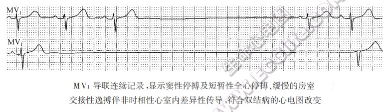 MV1导联连续记录，显示宴性停搏及短暂性全心停搏、缓慢的房室交接性逸搏伴非时相性心室内差异性传导，符合双结病的心电图改变（心电图）