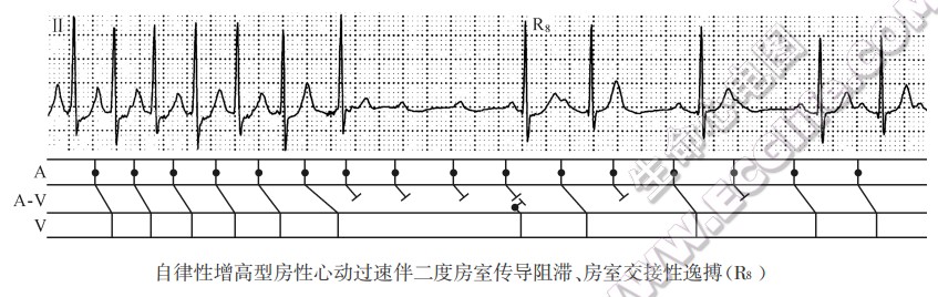 自律性增高型房性心动过速伴二度房室传导阻滞、房室交接性逸搏（心电图）