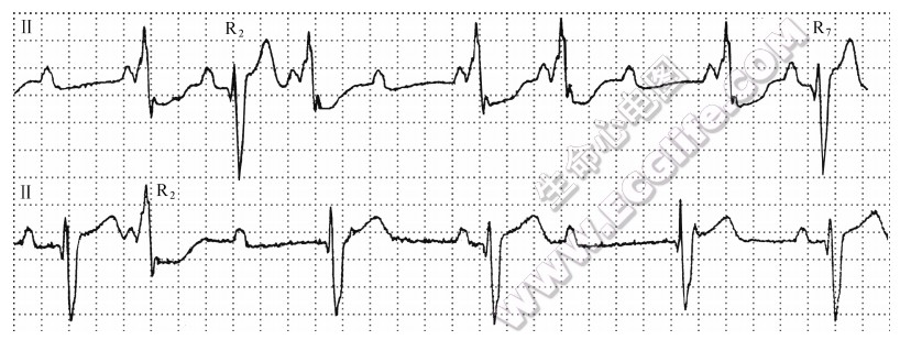 房室旁道内超常传导心电图