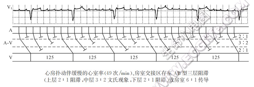 房室交接区内三层阻滞