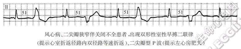 风心病、二尖瓣狭窄伴关闭不全患者，出现双形性室性早搏二联律（提示心室折返径路内双径路等速折返）、二尖瓣型P波（提示左心房肥大）