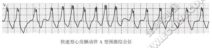 宽QRS心动过速诊断、鉴别诊断的步骤与方法