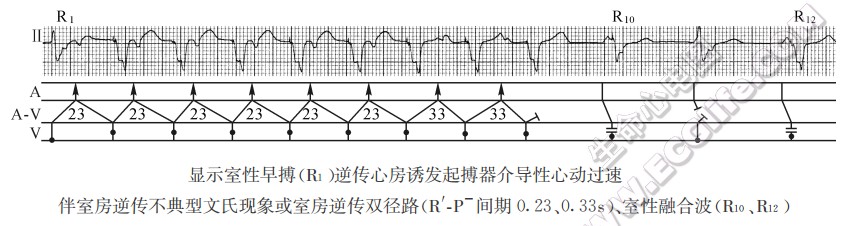 显示室性早搏(R1)逆传心房诱发起搏器介导性心动过速伴室房逆传不典型文氏现象或室房逆传双径路