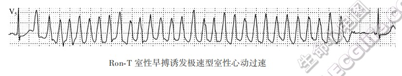 Ron-T室性早搏诱发极速型室性心动过速