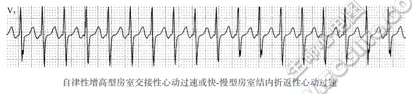 自律性增高型房室交接性心动过速或快．慢型房室结内折返性心动过速（心电图）